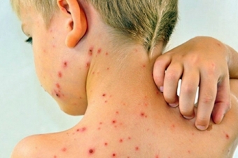 Filippində qızılcadan ölənlərin sayı 300-ə yaxınlaşır