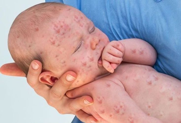 Qızılca peyvəndi məcburi oldu: Azərbaycanda vəziyyət necədir? - RƏSMİ