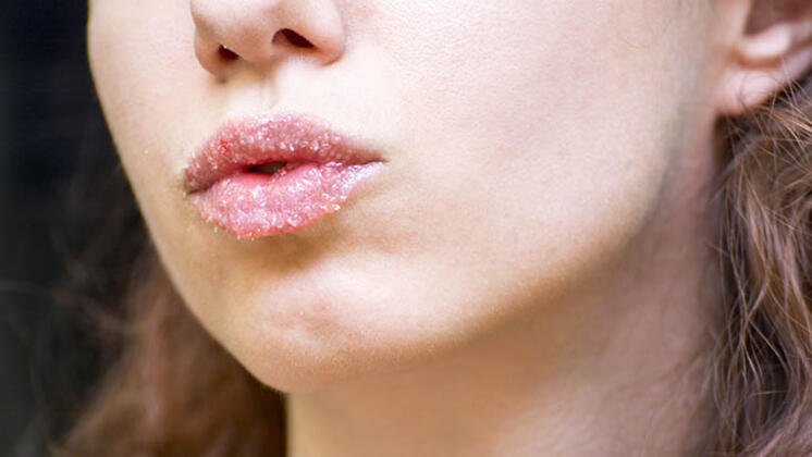 Quru dodaqları canlandıran şəkər pilinqi - <span style="color:red;">FOTO 