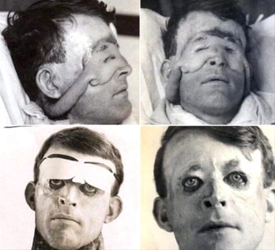 Tarixdə ilk plastik əməliyyat: Nəticə inanılmazdır... - FOTOLENT