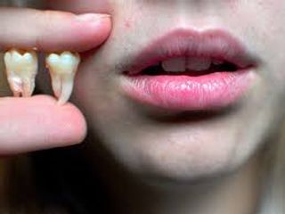  Diş çürükləri ölümə səbəb ola bilər