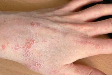 Azərbaycanda qarayara, qoturluq xəstəliklərinin sayı artıb