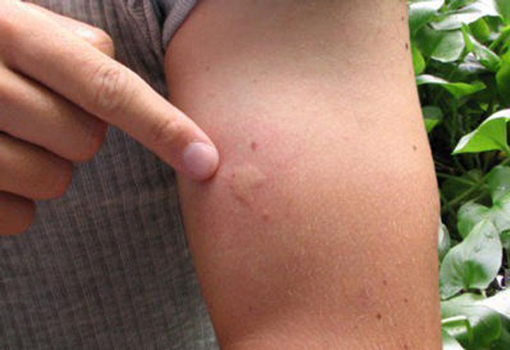 Ağcaqanad sancması: necə qorunmaq olar?