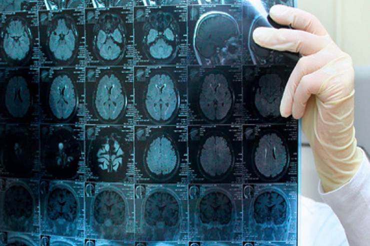 Müəmmalı ölümcül xəstəlik -  YADDAŞ İTİR... 