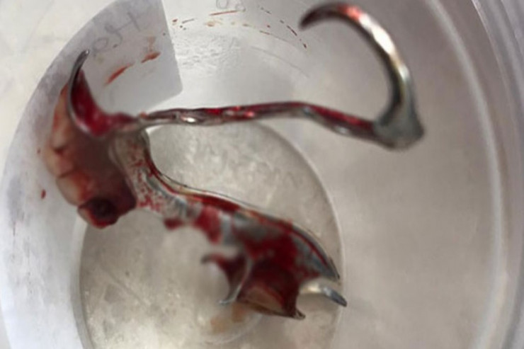 Qadının boğazından çıxan protez diş