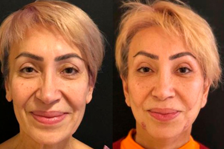 60 yaşlı Əməkdar artist cavanlaşmaq üçün ƏMƏLİYYAT ETDİRƏCƏK 