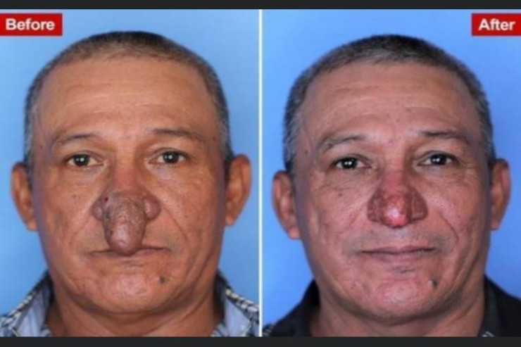 Burnu ağzına girdiyinə görə əməliyyat olundu -  FOTO  