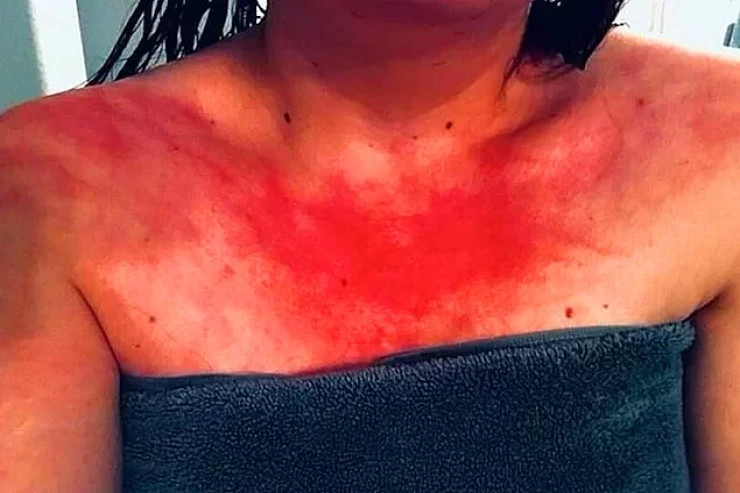 Su allergiyayasının qarşısını almaq mümkündürmü?