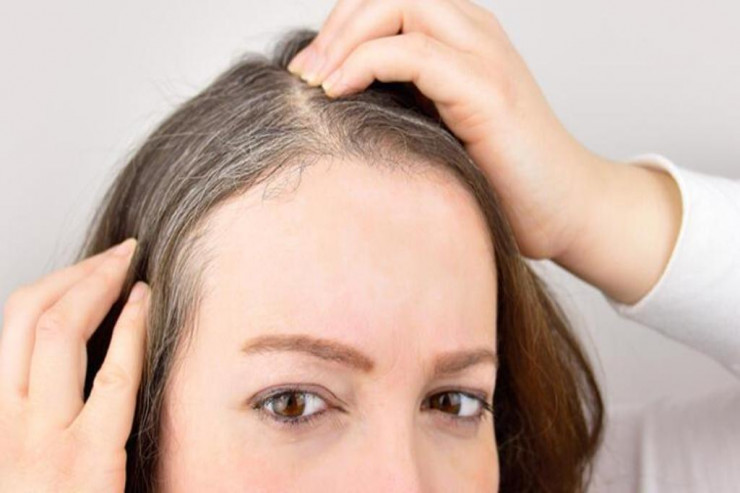 Ağ saçları necə yox etmək olar? – TƏBİİ ÜSULLAR 