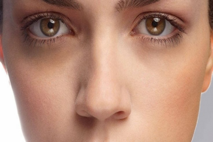 Göz ətrafında qaralmalar nədən xəbər verir?