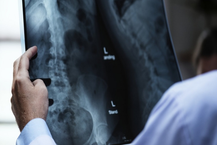 Xərçənglə bağlı miflər təkzib edildi