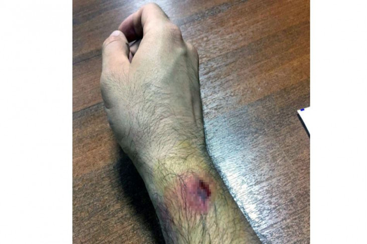 Zərərçəkmiş polisin qolu