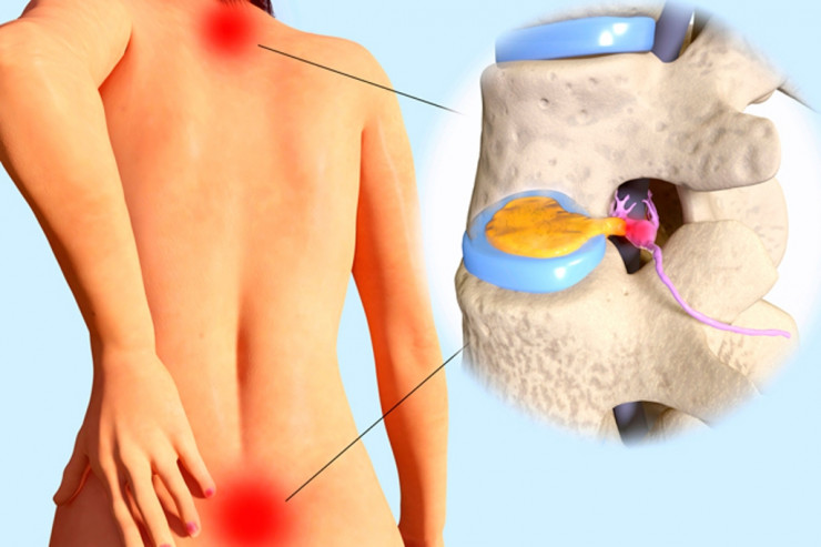 Fəqərəarası disk yırtıqları nə zaman əməliyyat olunmalıdır?- DİQQƏT 