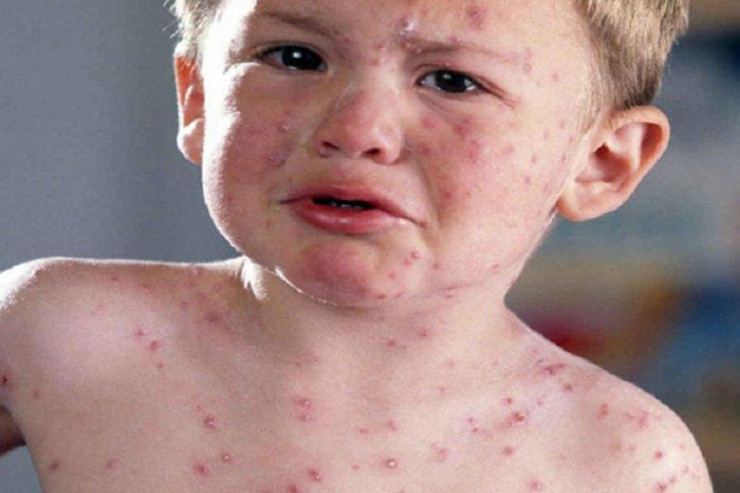 Uşaqlar arasında yayılan KOKSAKİ:  Ələmətləri və təhlükələri...