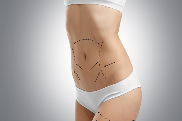 Dəbə çevrilən LİPOSAKSİYA  əməliyyatı kimlərə olmaz? - QİYMƏTLƏR 