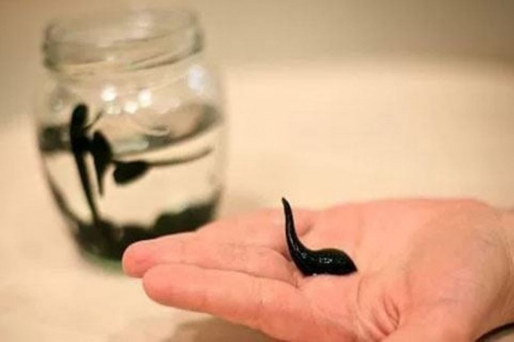 Zəli ilə peyvəndi bədəndən sovurmaq olarmı? - Professor  AÇIQLADI 