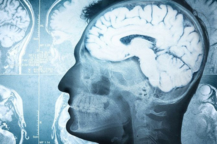 Tarixdə İLK DƏFƏ:  Parkinson xəstəsi sağaldı 