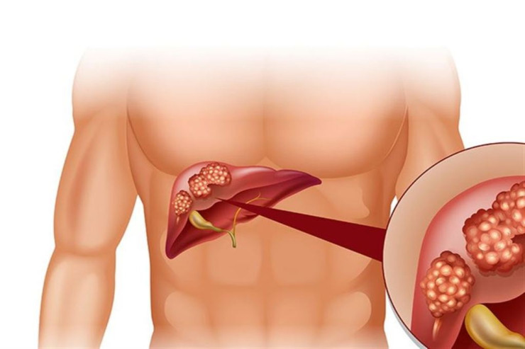 Qaraciyər xərçənginə   səbəb olan 5 vərdiş
