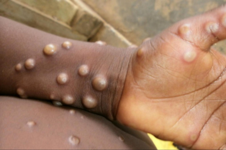 Meymunçiçəyinin ilkin əlamətləri nədir? - MÜSAHİBƏ 