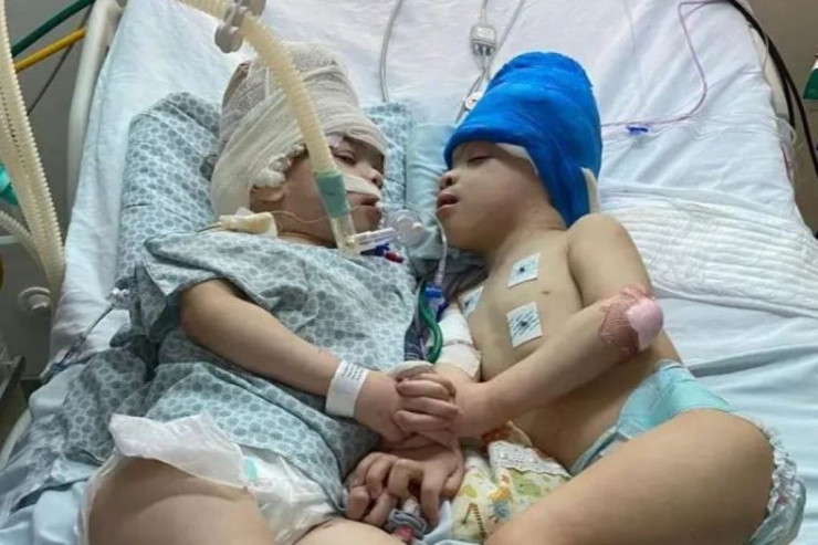 Siam əkizləri cərrahi müdaxilə ilə  ayrıldı