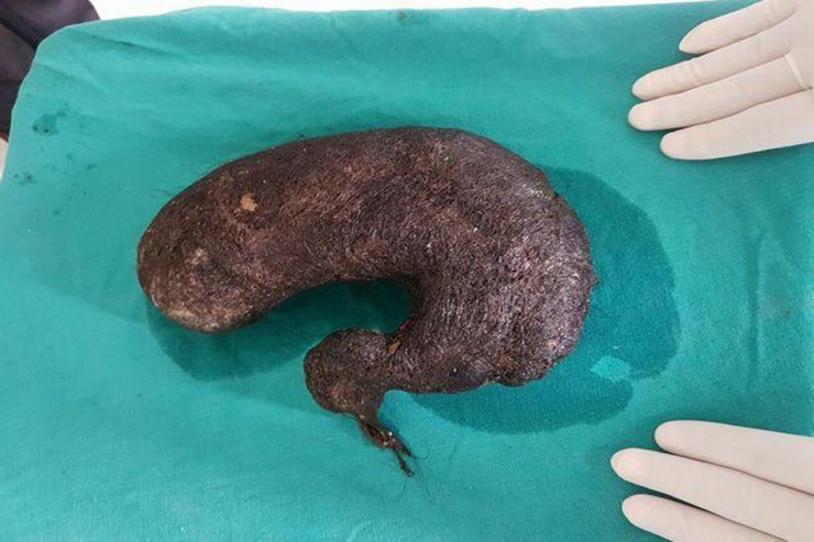 Mədəsindən 1,5 kilo  saç çıxdı 