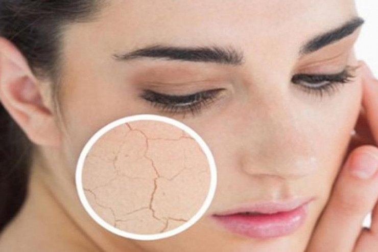 Dəri quruluğunun  yaranma SƏBƏBLƏRİ: Necə nəmləndirmək  olar?