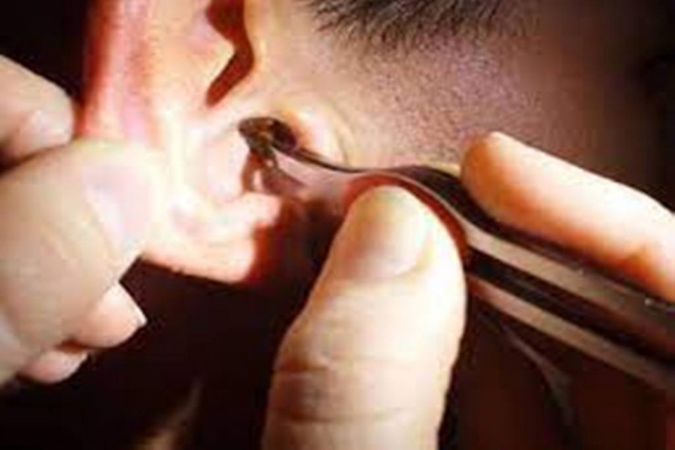 Nəhəng tarakan kişinin qulağını özünə “EV” etdi:  Həkim elə qışqırdı ki...