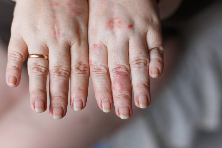 “Omicron”un qeyri-adi bir ƏLAMƏTİ  açıqlandı