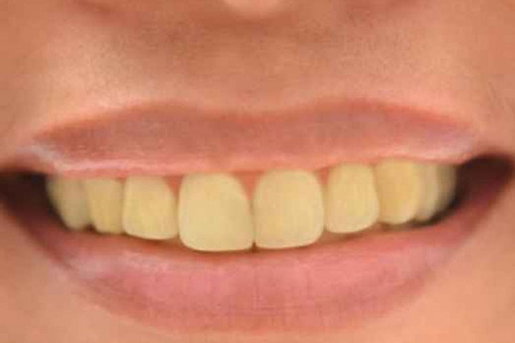 Dişlərin saralmasının SƏBƏBLƏRİ 