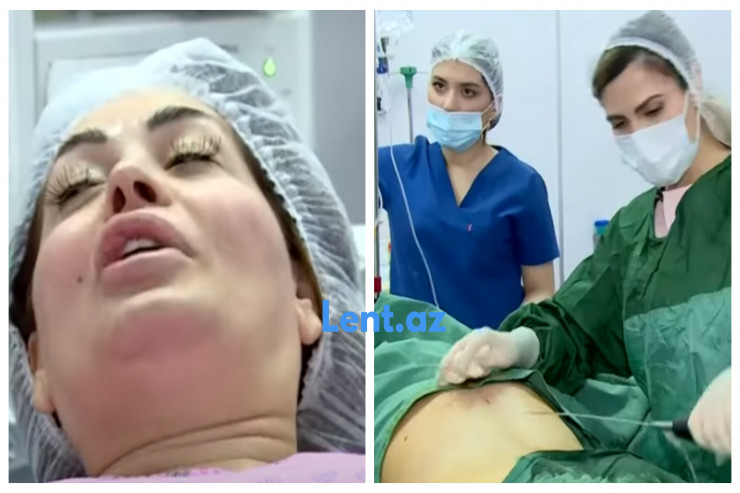 Azərbaycanlı müğənni cavanlaşmaq üçün ƏMƏLİYYAT ETDİRDİ  - VİDEO