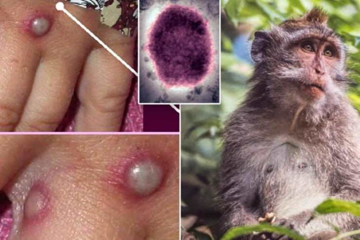 Azərbaycanda meymunçiçəyinə qarşı bu PEYVƏNDƏN  istifadə olunacaq - Baş infeksionist 