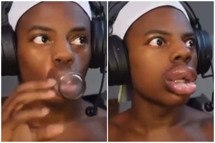 Dodaqlarına "botoks" edən fenomenin başına görün nə gəldi? - VİDEO 