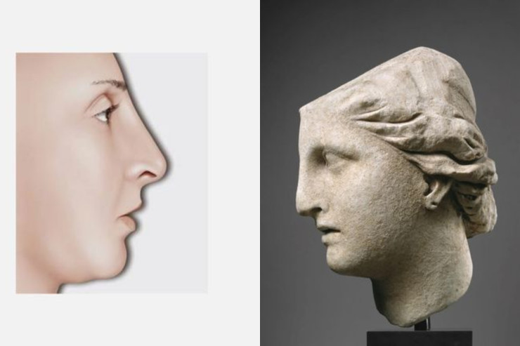  "Yunan burun" nədir,   plastik əməliyyatla düzəldilə bilərmi?