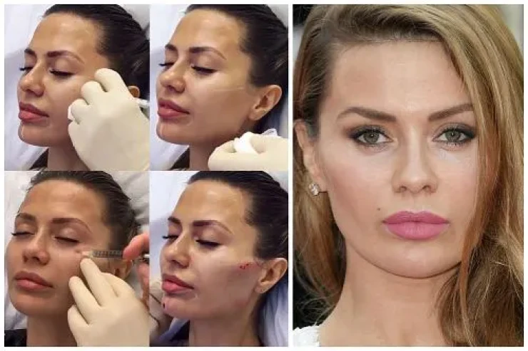 Dəfələrlə  plastik əməliyyat etdirən   məşhur model tanınmaz halda