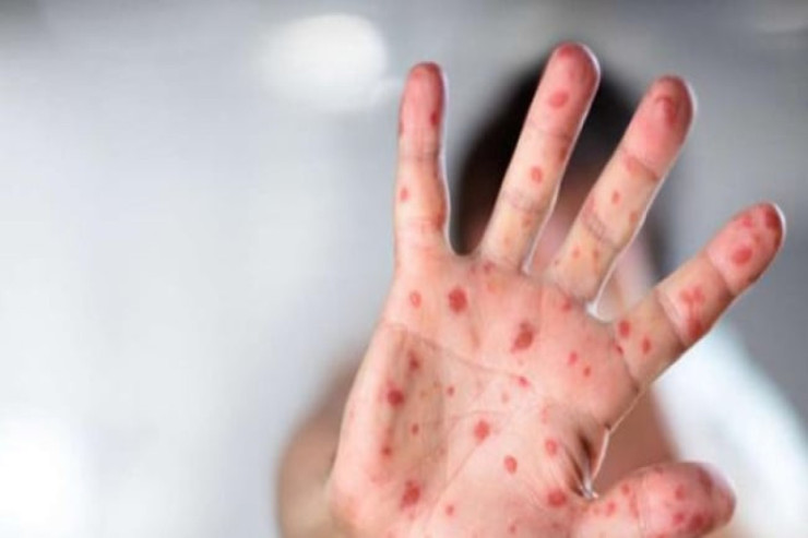 Şagirdi qızılcadan ölən məktəb DİSTANT TƏHSİLƏ KEÇDİ 