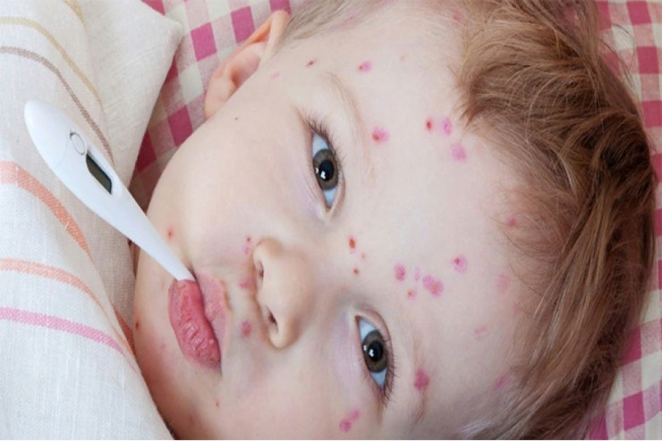 Ölkəni cənginə alan qızılca hansı hallarda ölümə səbəb olur? – PEDİATR DANIŞDI 