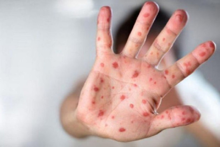 Daha bir məktəbli  qızılcadan   öldü - YENİLƏNİB 