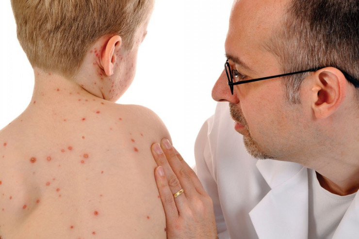 Qızılca xəstəsinə antibiotik vurmaq olarmı? - CAVAB  