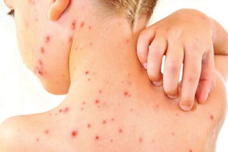 Qızılca ilə bağlı valideynlərə  ÇAĞIRIŞ 