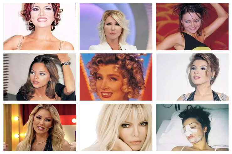 Məşhurlar necə dəfə  estetik əməliyyat   etdiriblər?