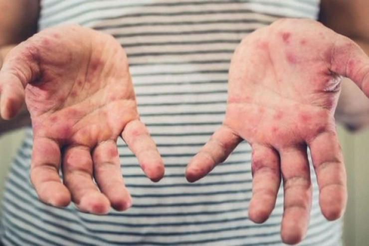 Qızılcanın hansı fəsadları ola bilər? - HƏKİMDƏN XƏBƏRDARLIQ 