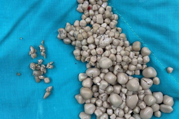 Qadının böyrəyində  300-dən çox daş   tapıldı