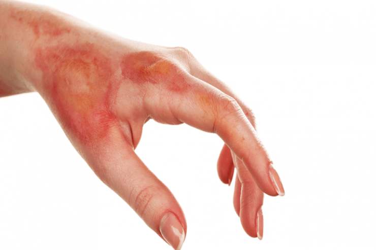 Yanıqlar zamanı ilk yardım nə olmalıdır? - CAVAB 