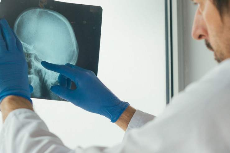 Tanınmış nevroloq insultun başlanğıc əlamətlərini   açıqladı