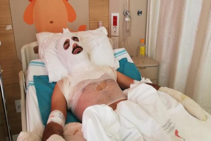 Tanınmış aktyor üzünü  yandırdı  - FOTO 