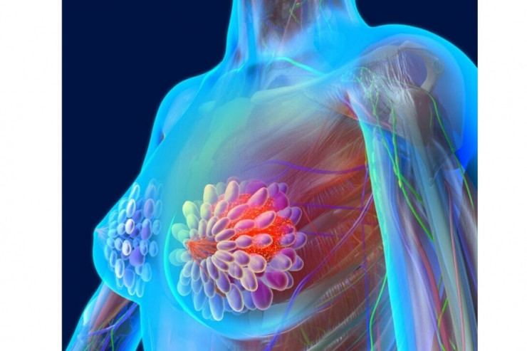 Döş xərçəngi ilə mübarizədə yeni kəşf 