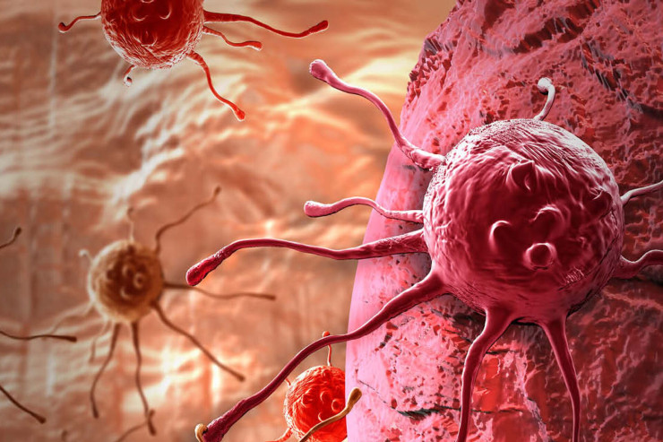 Xərçəngin gizli əlamətləri nələrdir? - ONKOLOQ AÇIQLADI 