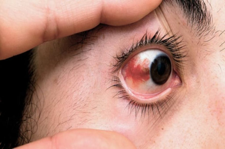 Gözlərin qızarması bu xəstəliyin  ƏLAMƏTİDİR 