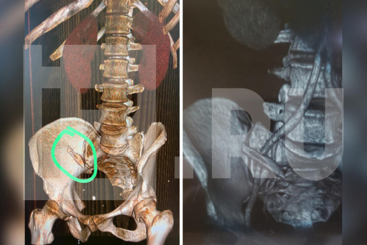 Həkimlər neştəri xəstənin bədənində  unutdular-FOTO 