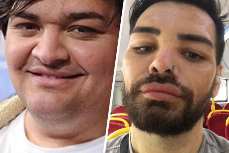 Müğənninin fanatı ona oxşamaq üçün 40-dan çox əməliyyat keçirdi 